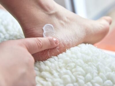 Caring for dry feet with treatments