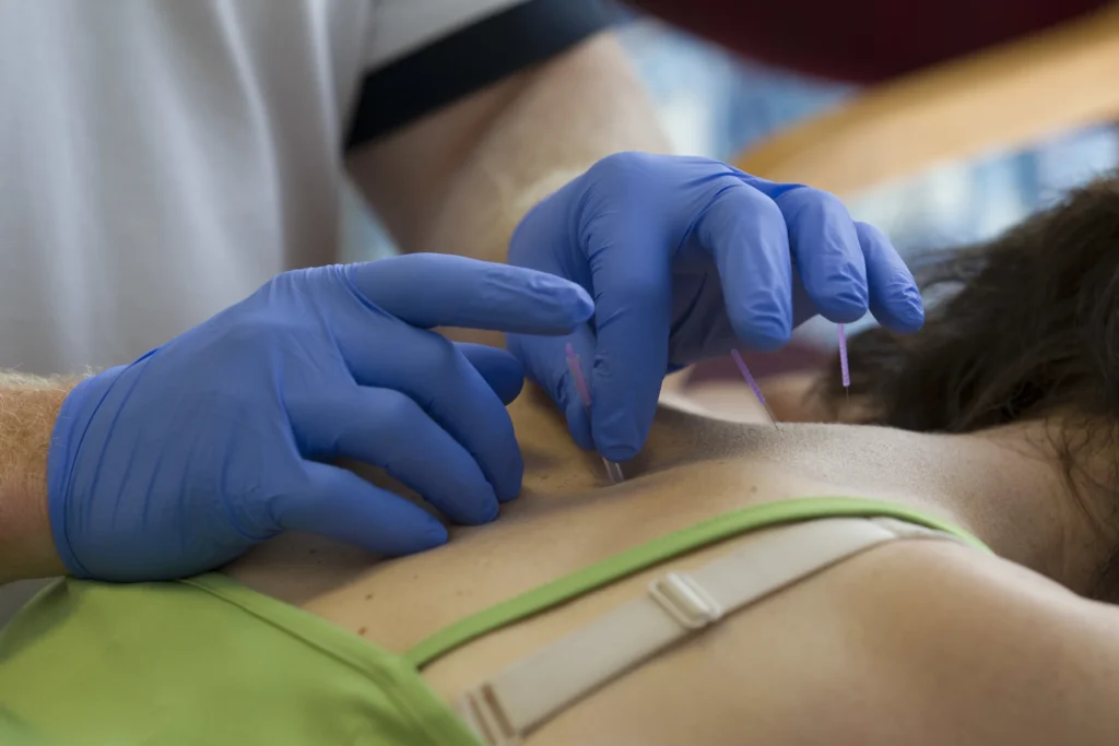 Female patient getting acupuncture treatment from a Spectrum Health Chartered Physiotherapist
