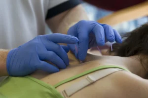 Female patient getting acupuncture treatment from a Spectrum Health Chartered Physiotherapist