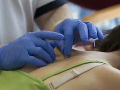 Female patient getting acupuncture treatment from a Spectrum Health Chartered Physiotherapist