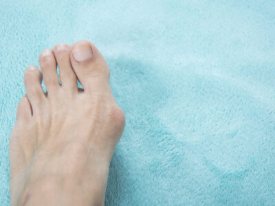 Persons foot showing a bunion