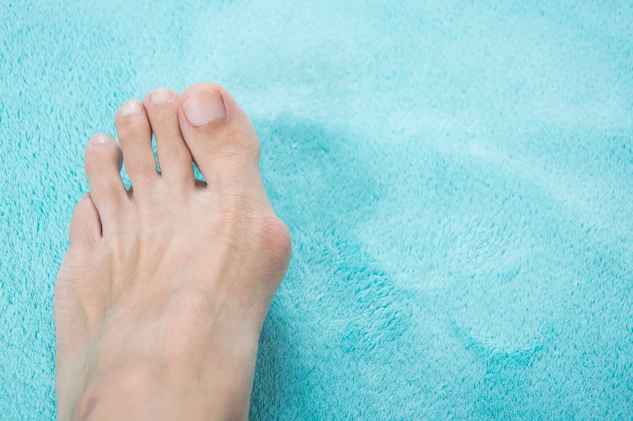 Persons foot showing a bunion