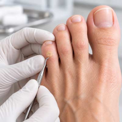 Fibrous corn on the foot being treated by podiatrist